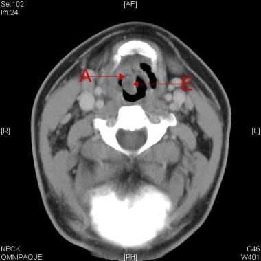 Computed tomography (CT) scan in an adult with acu
