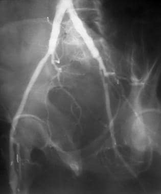 Peripheral bypass thrombolysis, case 3. The patien