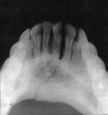 Mandibular fracture, occlusal radiograph. Courtesy