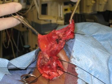 Intraoperative view of macrocystic lymphatic malfo