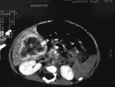 CT scan appears of a hemangioendothelioma. Note th