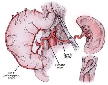 Mobilization of the stomach 