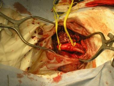 Circumferential exposure of common carotid artery 