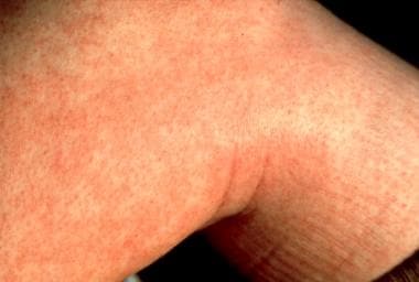 Rash associated with pharyngitis caused by Arcanob