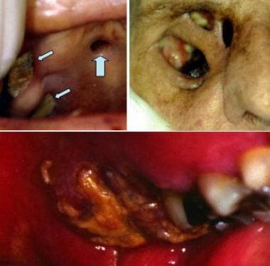 blastomycosis oral lesions