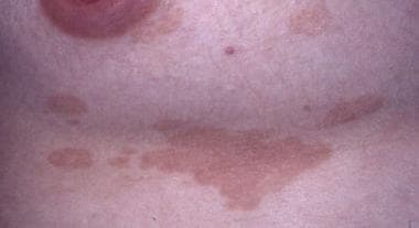 Tinea Versicolor: Practice Essentials, Pathophysiology, Etiology