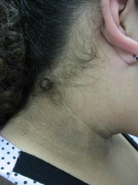 Acanthosis nigricans, obesity related. 