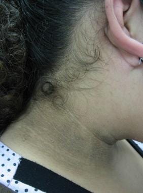 acanthosis nigricans neck