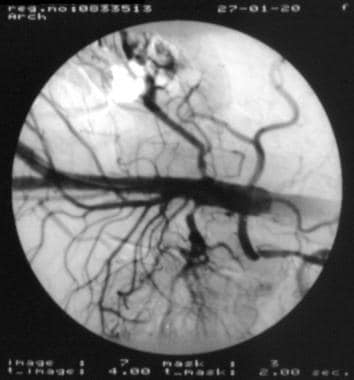 Angiogram of the descending aorta demonstrates the