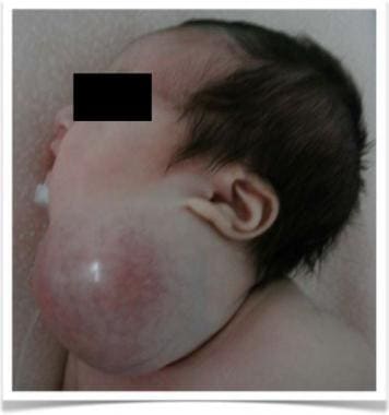 Clinical image of newborn with large macrocystic l