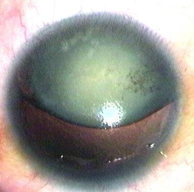 Aniridia with superiorly dislocated cataract. 