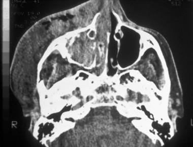 CT scan of the orbit demonstrating disruption of t