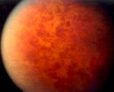 Peripheral fundus view of the same patient with ce