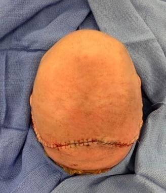Sagittal craniosynostosis after repair with scalp 