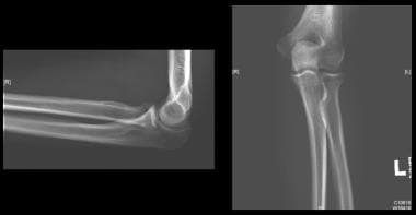 Minimally displaced radial head/neck fractures can