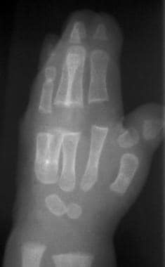 Radiograph of hand of 6-month-old patient with typ