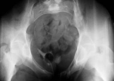 Open book pelvic injury, Radiology Reference Article