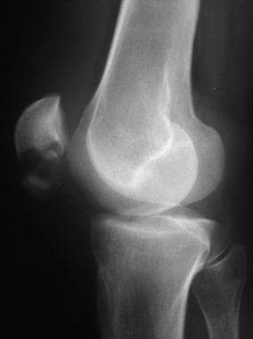 broken knee x ray