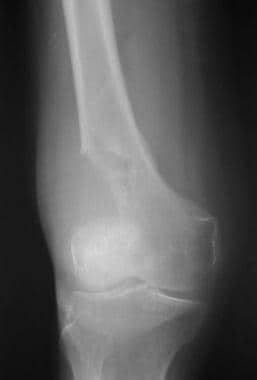 Radiograph shows osteolytic metastasis in the dist