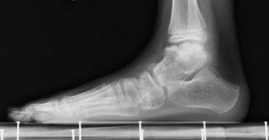 Lateral view of left foot. Medial ankle and subtal