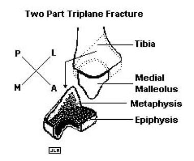 In a 2-part triplane fracture, 3 fracture lines ar