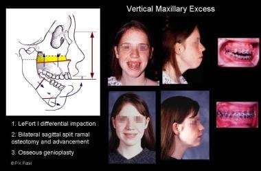 Illustration of vertical maxillary excess, apertog