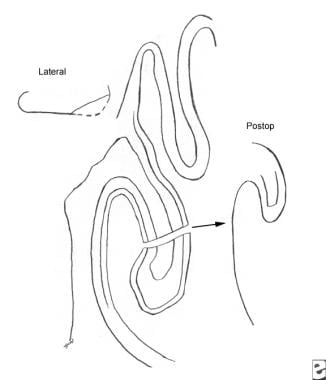Partial inferior turbinectomy. 