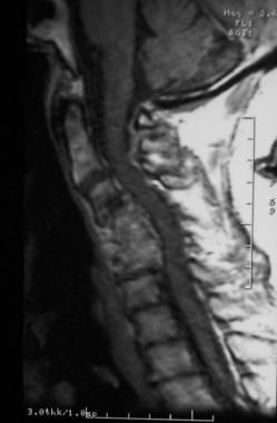 Cervical spine stenosis - London Neurosurgery - Spine