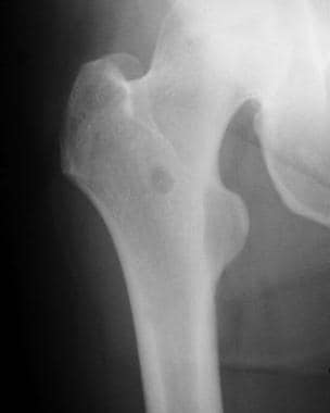 Radiograph of the right femur. This image demonstr