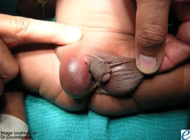 Perinatal testicular torsion. 