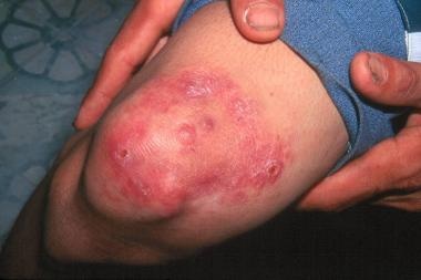 Chronic insensate patch due to leprosy infection. 