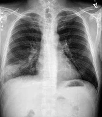 Plain chest radiograph in a patient with nocardios