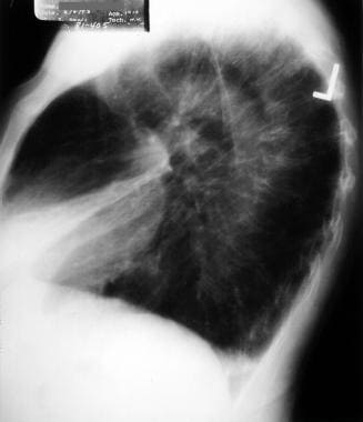 Atelectasis. Right middle lobe collapse on a later