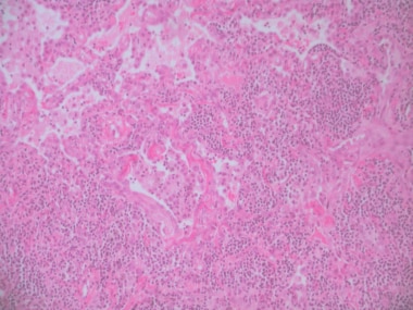 Lymphocytic interstitial pneumonitis, for which th