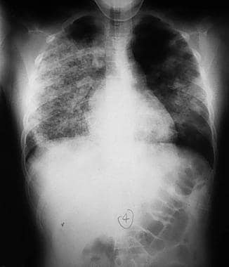 Shown is a chest radiograph of an 11-year-old girl