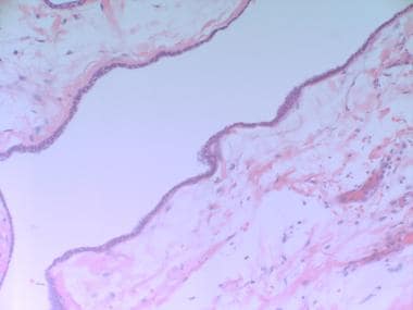 epididymal cyst histology