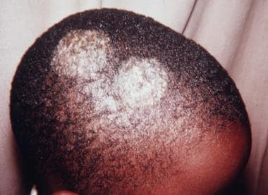 Tinea capitis; gray patch ringworm. Gray patch ref