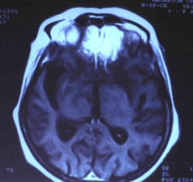 MRI axial view demonstrating extensive invasion of