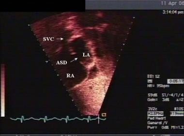 Subcostal echocardiographic view of a child with a