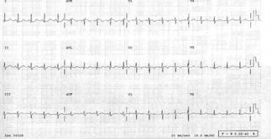 Electrocardiogram in 2-month-old infant with anoma