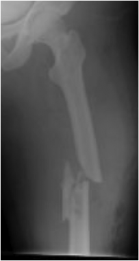 Radiograph of a high-energy femoral shaft fracture