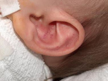 Example of ear bruising. Ear bruising is a rare ac