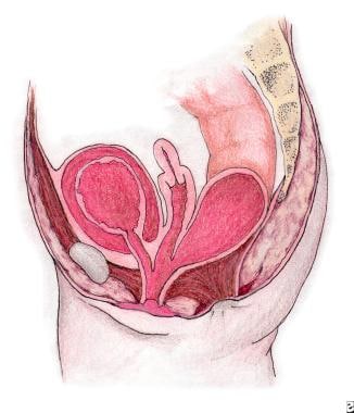 Fistula-in-Ano: Practice Essentials, Anatomy, Etiology