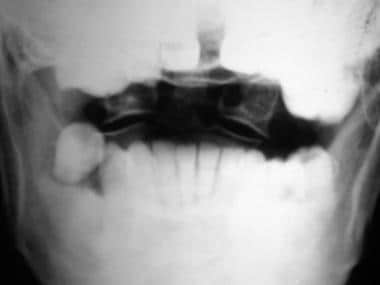 齿状突2型骨折。