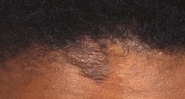 Forehead plaque in a patient with tuberous scleros