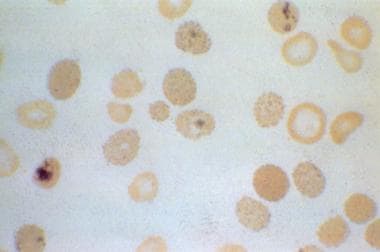 Supra vital stain in hemoglobin H disease that rev