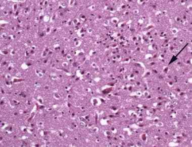 Severe acute hypoxic-ischemic neuronal change in t