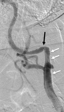 Post carotid stent placement. Following the placem