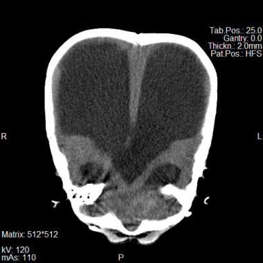 Noncontrast CT scan of brain of a 2-year-old boy s