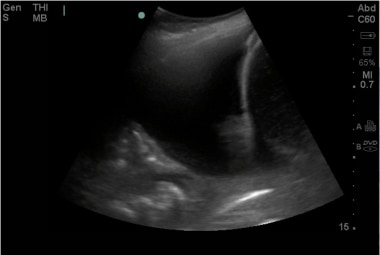 Ultrasound image of a large pleural effusion with 